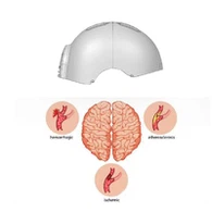 Vörös fényterápia Alzheimer-kórban
